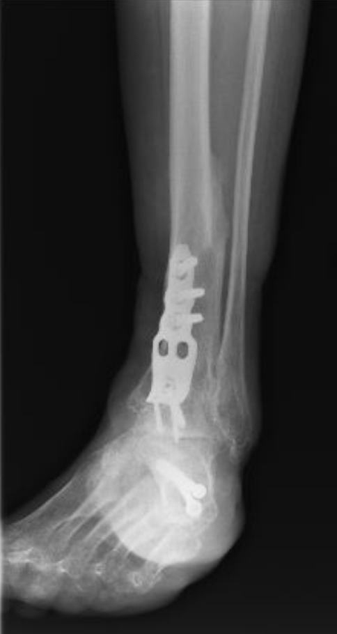 When A Patient Has An Equinovarus Contracture Secondary To A Neglected